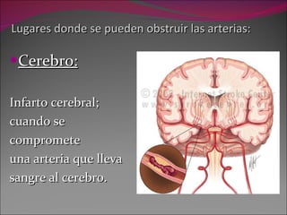 Lugares donde se pueden obstruir las arterias: Cerebro: Infarto cerebral;  cuando se compromete  una arteria que lleva  sangre al cerebro. 