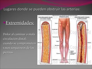 Lugares donde se pueden obstruir las arterias: Extremidades: Dolor al caminar o mala  circulación distal;  cuando se comprometen  vasos sanguíneos de las  piernas. 