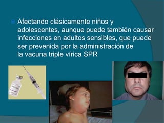  Afectando clásicamente niños y
adolescentes, aunque puede también causar
infecciones en adultos sensibles, que puede
ser prevenida por la administración de
la vacuna triple vírica SPR
 