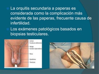  La orquitis secundaria a paperas es
considerada como la complicación más
evidente de las paperas, frecuente causa de
infertilidad.
 Los exámenes patológicos basados en
biopsias testiculares.
 .
 
