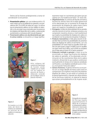 Vidal Ruíz CA y col. Displasia del desarrollo de la cadera
Rev Mex Ortop Ped 2013; 15(1); 6-87
www.medigraphic.org.mx
Dentro de los factores predisponentes a tomar en
consideración se encuentran:
• 	Presentación pélvica: con una incidencia de 8 a 10
veces mayor que en la población en general y una pre-
valencia del 10 al 50% de todos los casos, se estima
que la presentación pélvica con las rodillas en exten-
sión es la principal causa asociada para la presencia
de displasia del desarrollo de la cadera, ocasionando
acortamiento y contractura del músculo iliopsoas.6
• 	Presentación pélvica con alumbramiento por par-
to versus cesárea: se encuentra un riesgo significa-
tivamente mayor en nacimientos por parto que por
cesárea con una incidencia de hasta 1.31 veces más.
• 	Oligohidramnios: la carencia de líquido amniótico
durante las últimas fases de la etapa gestacional
se ha relacionado con un aumento en el riesgo de
presentación de displasia de cadera hasta cuatro
veces con respecto a la población en general.
• 	Primigesta: la falta de distensibilidad de las paredes
uterinas durante el primer embarazo provoca una
compresión mecánica directa a nivel coxofemoral
que duplica la posibilidad de displasia de cadera en
correlación con los productos de gestas multíparas.7
• 	Producto macrosómico: el alto peso durante el de-
sarrollo fetal aumenta las posibilidades de presentar
datos de displasia de cadera al nacimiento, con una
probabilidad 2.67 veces mayor en aquellos recién naci-
dos con peso igual o mayor a 4,000 g que en aquéllos
con peso menor de 2,500 g, por lo tanto se considera
que el bajo peso al nacer es un factor protector.8
• 	Embarazo múltiple o gemelar: si bien no se ha
encontrado un riesgo significativo de displasia
de cadera en gemelos, se ha observado una dis-
minución en los movimientos libres de la cadera
mediante ultrasonido lo que pudiera condicionar
eventualmente el retraso en la madurez acetabular
confinando a una displasia acetabular pura o inclu-
so una luxación franca de cadera.9
• 	Género femenino: el género femenino se encuen-
tra con un riesgo elevado de hasta cuatro veces en
comparación con el género masculino de presentar
displasia de cadera, ya que existe un aumento en
la laxitud ligamentaria y capsular por efecto directo
de las hormonas maternas, en especial la relaxina
que actúan primordialmente en las mujeres recién
Figura 1.
Niño indígena del
sureste de la península
de Yucatán, siendo
cargado por su madre
con las caderas en
posición de flexión y
abducción, conocido
por los Mayas como la
posición Kesmech.
Figura 2.
Se muestra a un niño
indio del Norte de
América con vestimenta
en posición de las
caderas en extensión y
aducción.
Figura 3.
Pictografía de Leonardo
Da Vinci que muestra
esquemáticamente el
dibujo de un producto
en presentación pélvica.
Altamente relacionado
con la presencia de
displasia del desarrollo de
la cadera, por la posición
de las caderas.
 