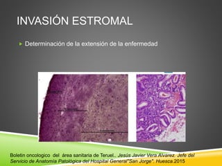 INVASIÓN ESTROMAL
 Determinación de la extensión de la enfermedad
Boletin oncologico del área sanitaria de Teruel.. Jesús Javier Vera Alvarez. Jefe del
Servicio de Anatomía Patológica del Hospital General"San Jorge". Huesca.2015
 