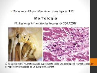 • Pocas veces FR por infección en otros lugares: PIEL
Morfología
FR: Lesiones inflamatorias focales  CORAZÓN
A. Valvulitis mitral reumática aguda superpuesta sobre una cardiopatía reumática crónica
B. Aspecto microscópico de un cuerpo de Aschoff
 