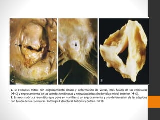 C. D Estenosis mitral con engrosamiento difuso y deformación de valvas, mas fusión de las comisuras
( C) y engrosamiento de las cuerdas tendinosas y neovascularización de valva mitral anterior ( D).
E. Estenosis aórtica reumática que pone en manifiesto un engrosamiento y una deformación de las cúspides
con fusión de las comisuras. Patología Estructural Robbins y Cotran. Ed 18
 