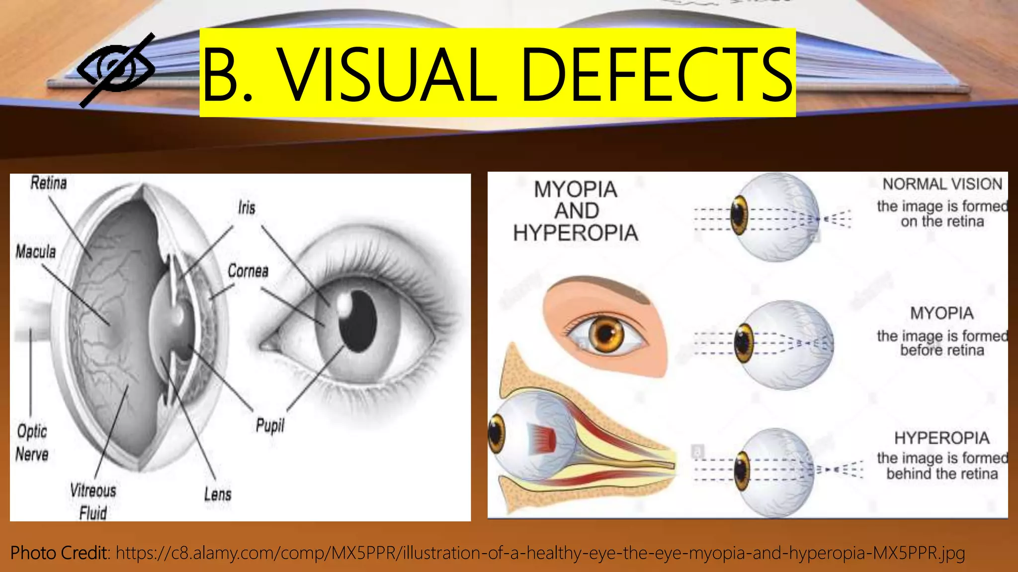 B. VISUAL DEFECTS
Photo Credit: https://c8.alamy.com/comp/MX5PPR/illustration-of-a-healthy-eye-the-eye-myopia-and-hyperopia-MX5PPR.jpg
 