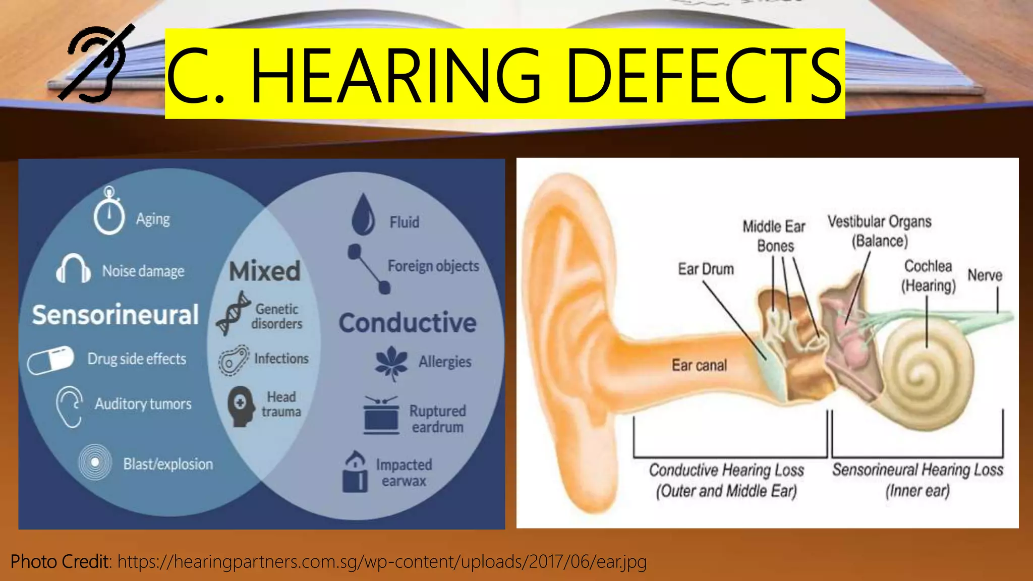 C. HEARING DEFECTS
Photo Credit: https://hearingpartners.com.sg/wp-content/uploads/2017/06/ear.jpg
 