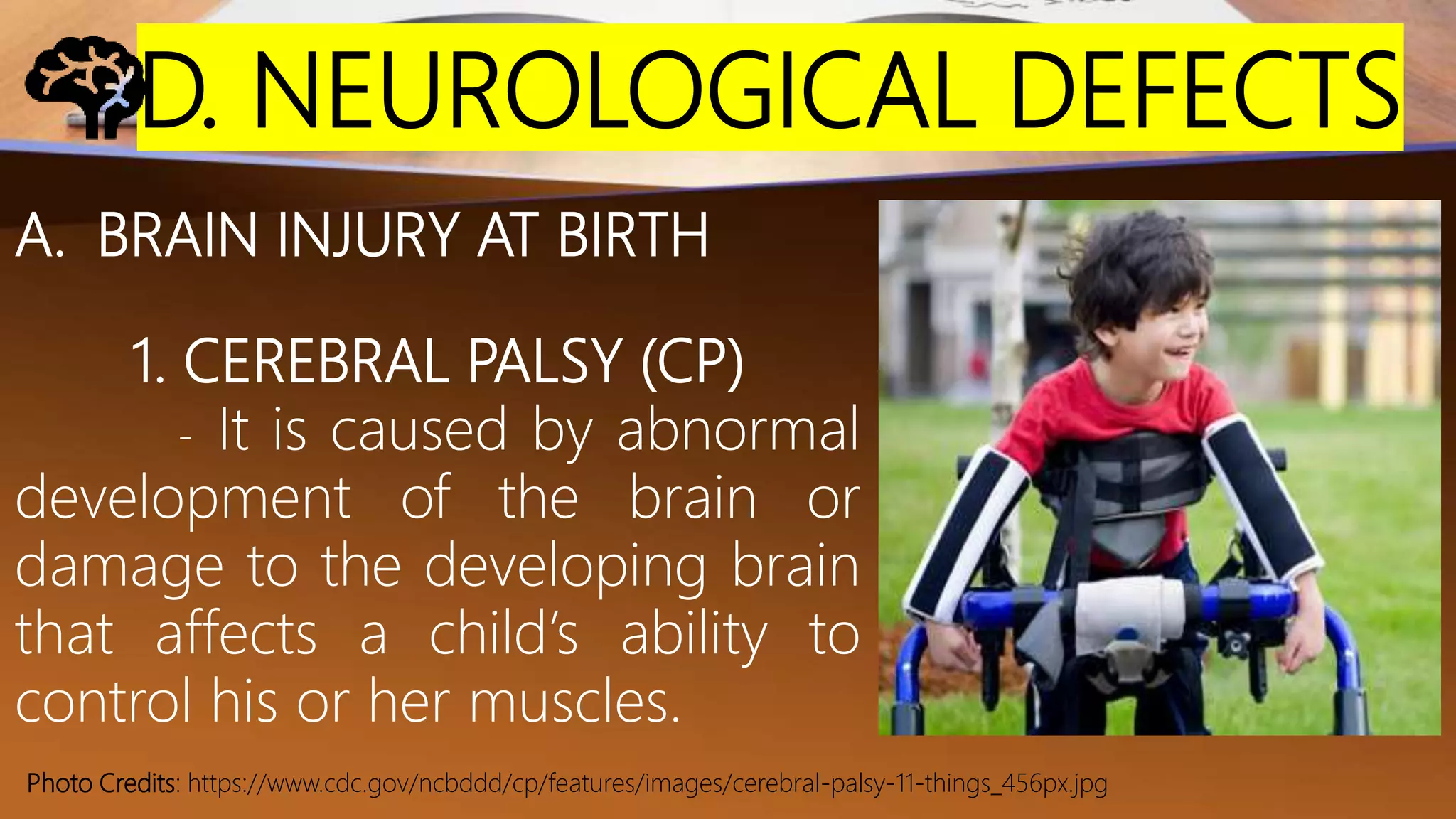 D. NEUROLOGICAL DEFECTS
A. BRAIN INJURY AT BIRTH
1. CEREBRAL PALSY (CP)
- It is caused by abnormal
development of the brain or
damage to the developing brain
that affects a child’s ability to
control his or her muscles.
Photo Credits: https://www.cdc.gov/ncbddd/cp/features/images/cerebral-palsy-11-things_456px.jpg
 