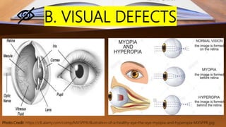 B. VISUAL DEFECTS
Photo Credit: https://c8.alamy.com/comp/MX5PPR/illustration-of-a-healthy-eye-the-eye-myopia-and-hyperopia-MX5PPR.jpg
 