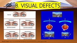B. VISUAL DEFECTS
Photo Credit: https://aryashafa.files.wordpress.com/2015/04/info_a_static.jpg?w=640
 