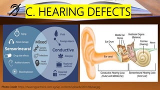 C. HEARING DEFECTS
Photo Credit: https://hearingpartners.com.sg/wp-content/uploads/2017/06/ear.jpg
 