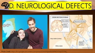 D. NEUROLOGICAL DEFECTS
Photo Credit: https://lh3.googleusercontent.com/proxy/e24UKXfjgApfb20PMOYTmpCfY7Mj_
 