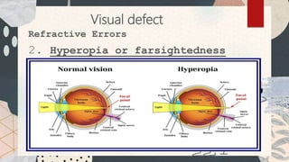 Hypermyopia Visual Defect Factors affecting reading | PPTX
