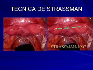 TECNICA DE STRASSMAN 
