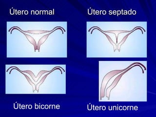Útero normal  Útero septado Útero bicorne Útero unicorne 