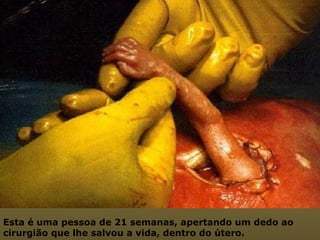 Esta é uma pessoa de 21 semanas, apertando um dedo ao cirurgião que lhe salvou a vida, dentro do útero.  