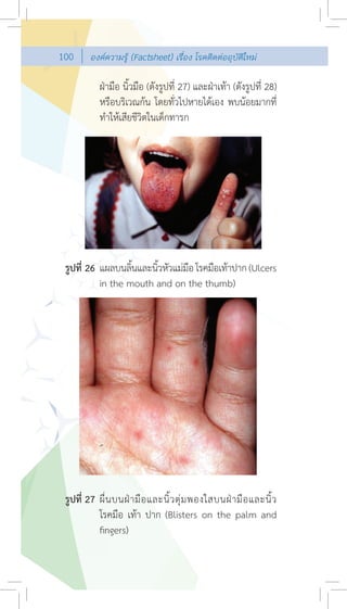 100     องคความรู (Factsheet) เรื่อง โรคติดตออุบัติใหม

            ฝามือ นิ้วมือ (ดังรูปที่ 27) และฝาเทา (ดังรูปที่ 28)
            หรือบริเวณกน โดยทั่วไปหายไดเอง พบนอยมากที่
            ทําใหเสียชีวิตในเด็กทารก




 รูปที่ 26 แผลบนลินและนิวหัวแมมอ โรคมือเทาปาก (Ulcers
                   ้    ้       ื
           in the mouth and on the thumb)




 รูปที่ 27 ผื่ น บนฝ า มื อ และนิ้ ว ตุ ม พองใสบนฝ า มื อ และนิ้ ว
           โรคมือ เทา ปาก (Blisters on the palm and
           ﬁngers)
 