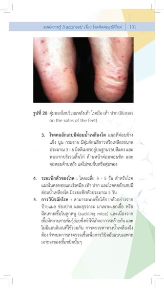 องคความรู (Factsheet) เรื่อง โรคติดตออุบัติใหม   101




รูปที่ 28 ตุมพองใสบริเวณหลังเทา โรคมือ เทา ปาก (Blisters
            
          on the soles of the feet)

    3. โรคคออักเสบมีตอมนํ้าเหลืองโต แผลที่คอนขาง
       แข็ง นูน กระจาย มีตุมกอนสีขาวหรือเหลืองขนาด
       ประมาณ 3 - 6 มิลลิเมตรอยูบนฐานรอบสีแดง และ
       พบมากบริเวณลิ้นไก ดานหนาตอมทอนซิล และ
       คอหอยดานหลัง แตไมพบผื่นหรือตุมพอง

4. ระยะฟกตัวของโรค : โดยเฉลี่ย 3 - 5 วัน สําหรับโรค
   แผลในคอหอยและโรคมือ เทา ปาก และโรคคออักเสบมี
   ตอมนํ้าเหลืองโต มีระยะฟกตัวประมาณ 5 วัน
5. การวินิจฉัยโรค : สามารถพบเชื้อไดจากตัวอยางจาก
   ปายแผล ชองปาก และอุจจาระ มาเพาะแยกเชื้อ หรือ
   ฉีดเพาะเชื้อในลูกหนู (suckling mice) และเนื่องจาก
   เชือมีหลายสายพันธุยอยซึงทําใหเกิดอาการคลายกัน และ
      ้                  ่
   ไมมีแอนติเจนที่ใชรวมกัน การตรวจหาทางนํ้าเหลืองจึง
   ตองกําหนดการสงตรวจเชื้อเพื่อการวินิจฉัยแบบเฉพาะ
   เจาะจงของเชื้อชนิดนั้นๆ
 