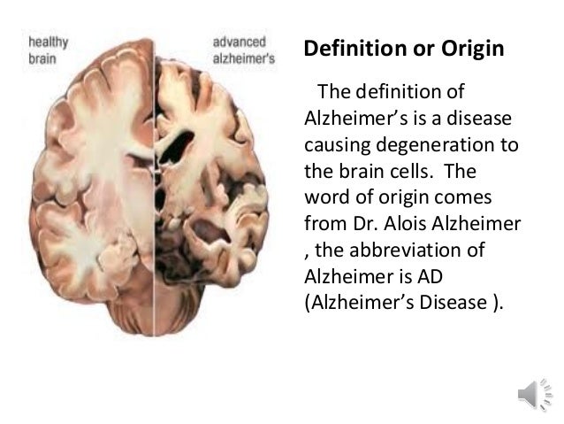 Alzheimer y perdida de peso