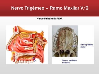 Nervo Trigêmeo – Ramo Maxilar V/2
          Nervo Palatino MAIOR
 