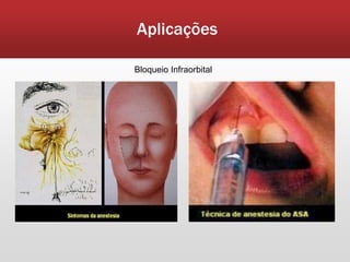 Aplicações

Bloqueio Infraorbital
 
