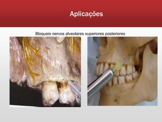 Aplicações

Bloqueio nervos alveolares superiores posteriores
 
