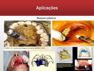 Aplicações

Bloqueio palatinos
 