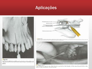 Aplicações
 