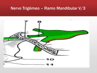 Nervo Trigêmeo – Ramo Mandibular V/3
 