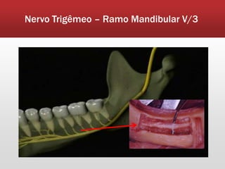 Nervo Trigêmeo – Ramo Mandibular V/3
 
