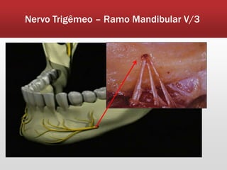 Nervo Trigêmeo – Ramo Mandibular V/3
 