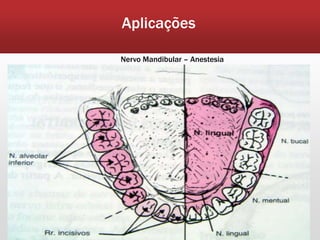 Aplicações

Nervo Mandibular – Anestesia
 