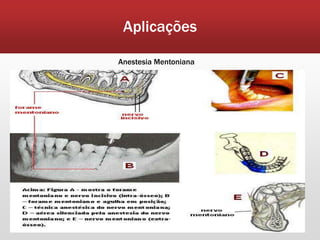 Aplicações

Anestesia Mentoniana
 