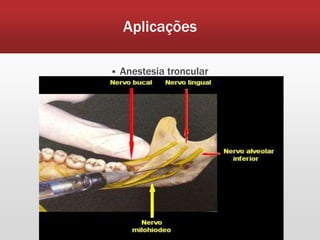Aplicações

   Anestesia troncular
 