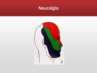 Neuralgia
 