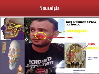 Neuralgia
 