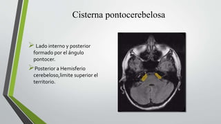 Cisterna pontocerebelosa
Lado interno y posterior
formado por el ángulo
pontocer.
Posterior a Hemisferio
cerebeloso,limite superior el
territorio.
 