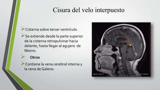 Cisura del velo interpuesto
Cisterna sobre tercer ventrículo .
Se extiende desde la parte superior
de la cisterna retropulvinar hacia
delante, hasta llegar al agujero de
Monro.
 Otros
Contiene la vena cerebral interna y
la vena de Galeno.
 