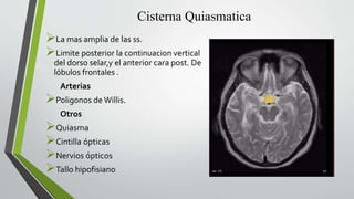 Cisterna Quiasmatica
La mas amplia de las ss.
Limite posterior la continuacion vertical
del dorso selar,y el anterior cara post. De
lóbulos frontales .
Arterias
Polig0nos de Willis.
Otros
Quiasma
Cintilla ópticas
Nervios ópticos
Tallo hipofisiano
 