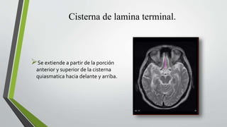 Cisterna de lamina terminal.
Se extiende a partir de la porción
anterior y superior de la cisterna
quiasmatica hacia delante y arriba.
 