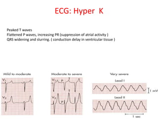 ECG: Hyper K
Peaked T waves
Flattened P waves, increasing PR (suppression of atrial activity )
QRS widening and slurring. ( conduction delay in ventricular tissue )
 