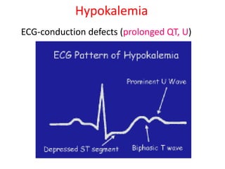 Hypokalemia
ECG-conduction defects (prolonged QT, U)
 