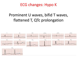 ECG changes: Hypo K
Prominent U waves, bifid T waves,
flattened T, QTc prolongation
 