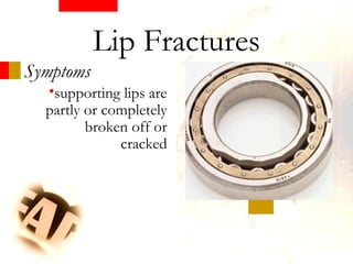 •supporting lips are
partly or completely
broken off or
cracked
Symptoms
Lip Fractures
 