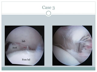 Case 3 
lab 
Fem hd 
Acet 
 