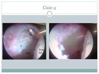 Case 4 
Fem 
hd 
L 
Acet 
 