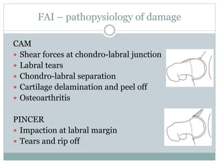 FAI – pathopysiology of damage 
CAM 
 Shear forces at chondro-labral junction 
 Labral tears 
 Chondro-labral separation 
 Cartilage delamination and peel off 
 Osteoarthritis 
PINCER 
 Impaction at labral margin 
 Tears and rip off 
 