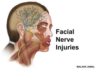 Facial
Nerve
Injuries
MALAAK JAMAL
 