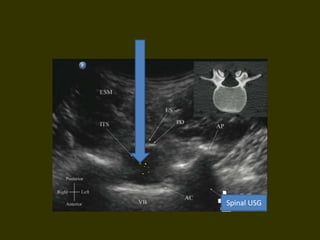 Spinal USG
 