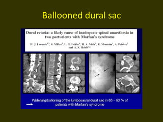 Ballooned dural sac
 