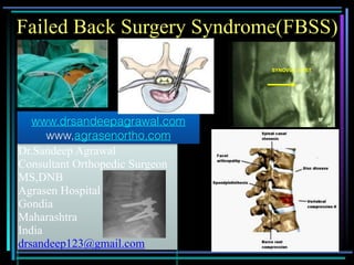1
Dr.Sandeep Agrawal
Consultant Orthopedic Surgeon
MS,DNB
Agrasen Hospital
Gondia
Maharashtra
India
drsandeep123@gmail.com
www.drsandeepagrawal.com
www,agrasenortho.com
Failed Back Surgery Syndrome(FBSS)
SYNOVIAL CYST
 
